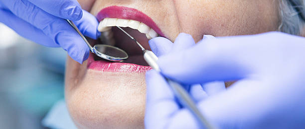 Emergency Dental Filling Replacement in FL